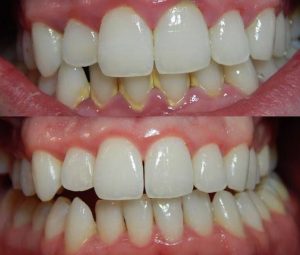 Keep teeth plaque away