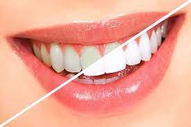 cosmetic dentistry enhances smiles